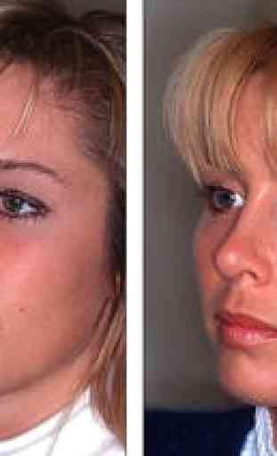 Facial Plastic Surgery: Avant et Après 1