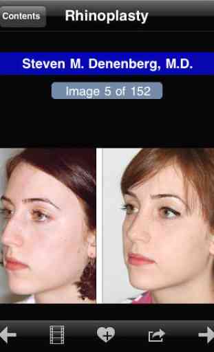 Facial Plastic Surgery: Avant et Après 3