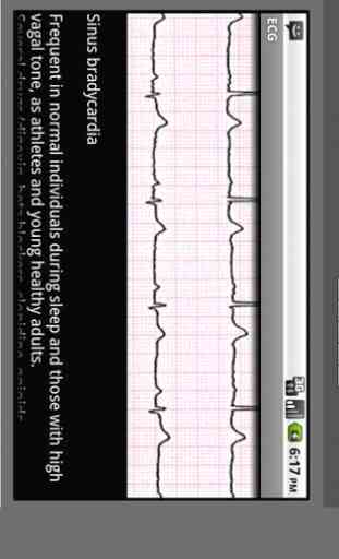 Electrocardiogram ECG Types 3