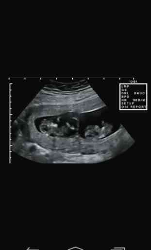 Prenatal Ultrasound Lite 4