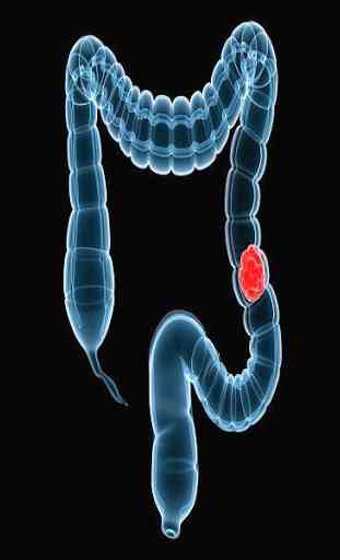 Le cancer du colon & du rectum 1