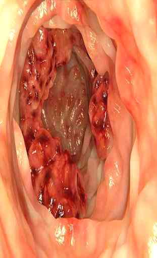 Le cancer du colon & du rectum 2