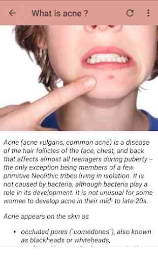 Traitement de l'acné 2