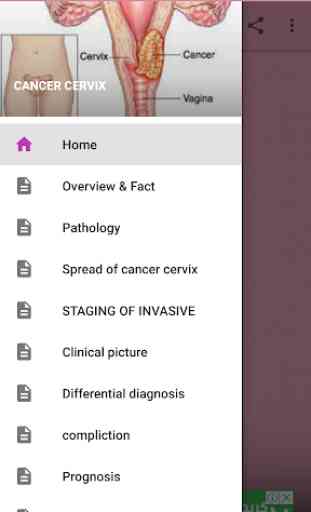 Cancer Cervix Fact 3
