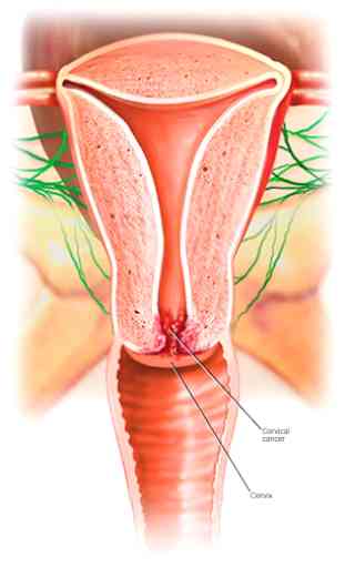 Cervical Cancer 3