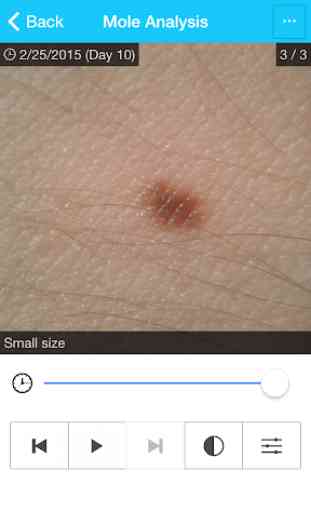 MySkinPal - Skin Cancer App 2