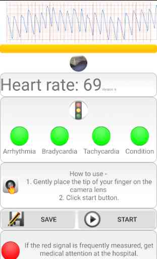 Diagnostic cardiaque>fréquence cardiaque, arythmie 3