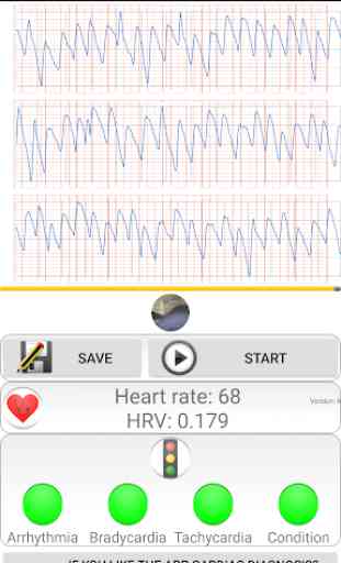 Diagnostic cardiaque>fréquence cardiaque, arythmie 4