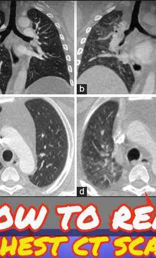 Guide to Interpretation of CT chest 2