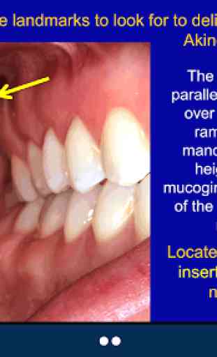 Dental Anesthesia - SecondLook 3