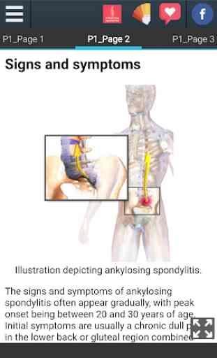 Ankylosing Spondylitis Info 4