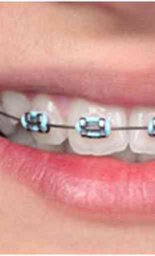 Real Teeth Braces Photo Maker 4