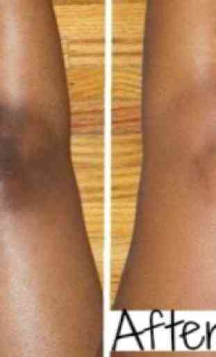 Bleaching the knees guide 2