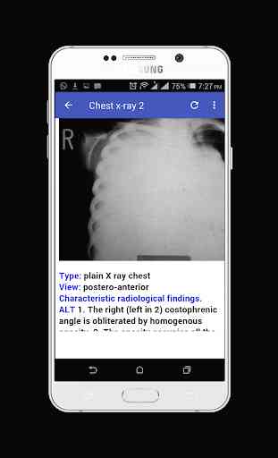 Chest X-ray Easy Learning 2