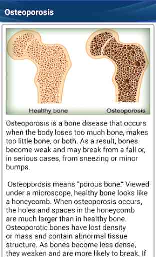 Osteoporosis Low Bone Density Weak Bones Diet Help 2