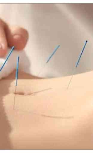 Cours d'acupuncture initial. 2