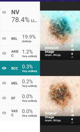 Visus: Skin Cancer Detection 3