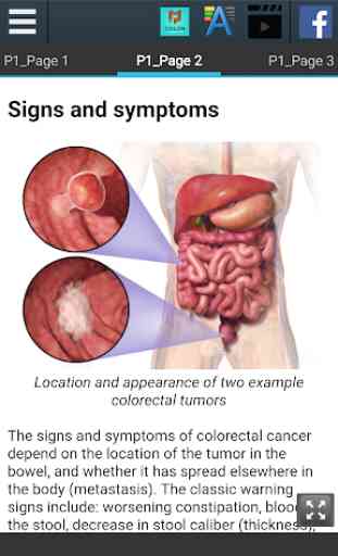 Colon Cancer Info 3