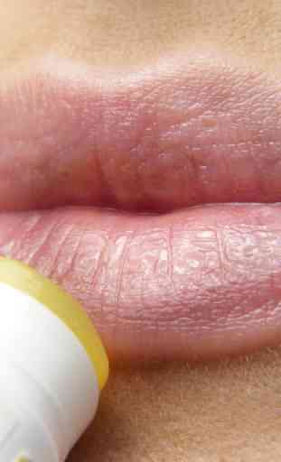 Herpes Treatment And Symptoms 2