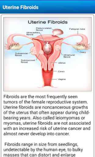 Uterine Fibroid Causes Symptoms Types & Treatment 2