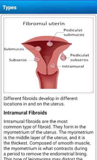 Uterine Fibroid Causes Symptoms Types & Treatment 3