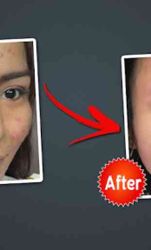Object Remover -Erase Object -Face Blemish Remover 4