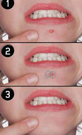 Effaceur d'imperfections LITE (Pimple Eraser LITE) 4
